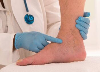 Learn more about varicose veins