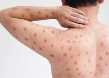 Two more states are affected by the tomato flu outbreak in India