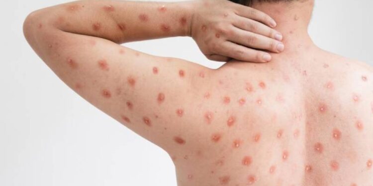 Two more states are affected by the tomato flu outbreak in India